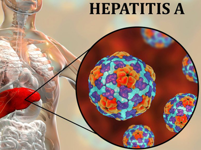 Hepatitis A